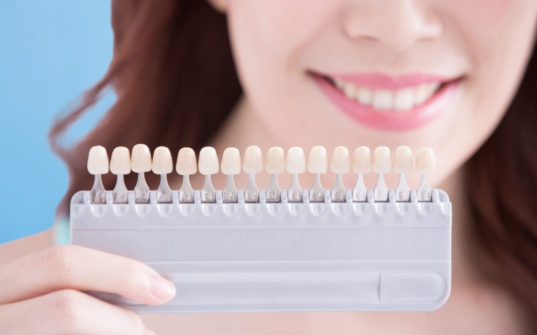 10 Things to Know Before Choosing Porcelain Veneers